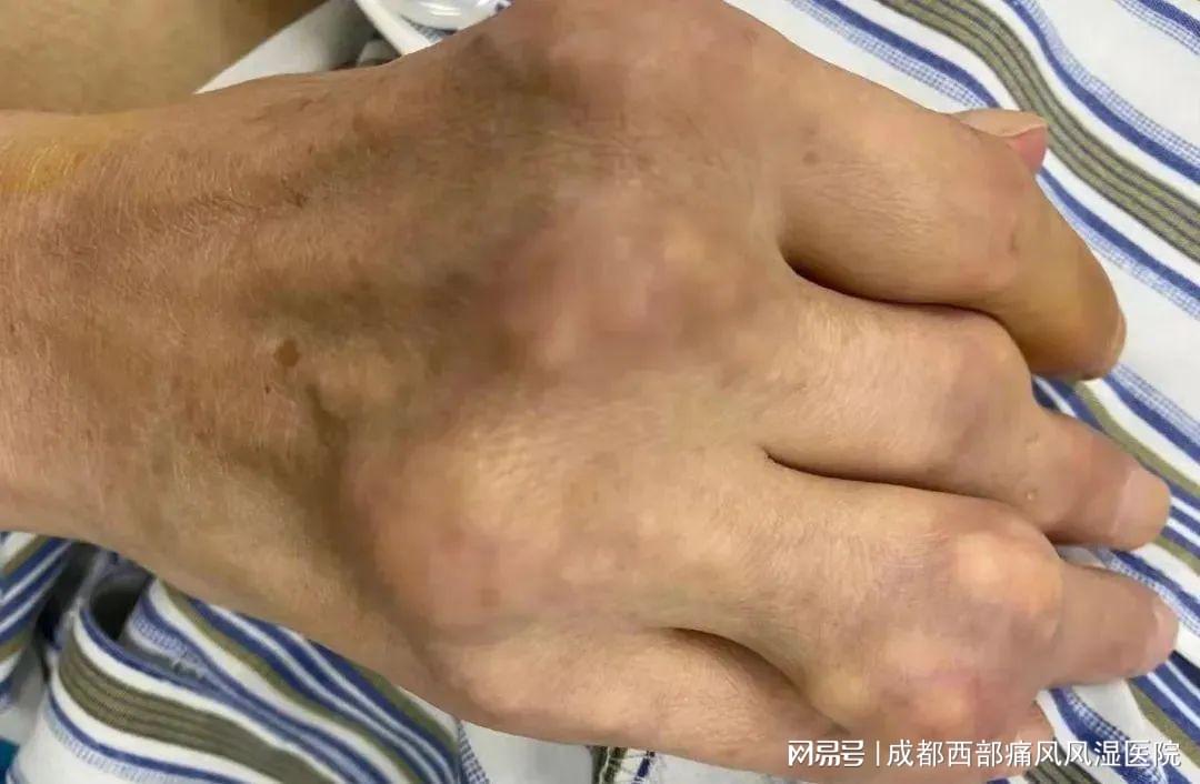 男子双手长满痛风石无法工作