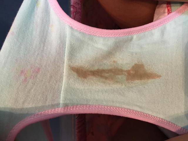 女孩经期咳血查出子宫内膜跑到肺部